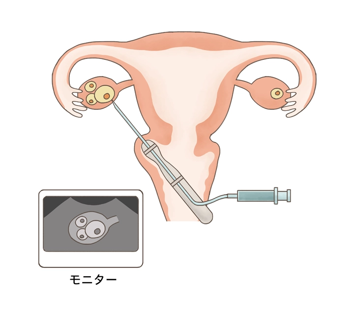 採卵